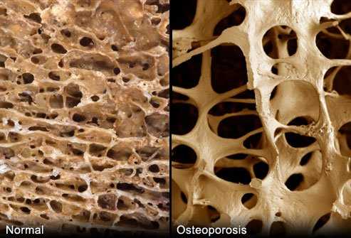 Osteoporosis effect on bone density
